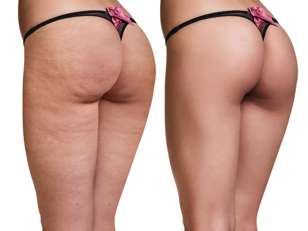 Rimedi contro la cellulite